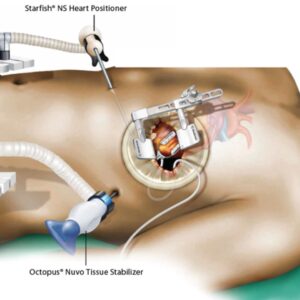 Minimally Invasive Cardiac Bypass Surgery