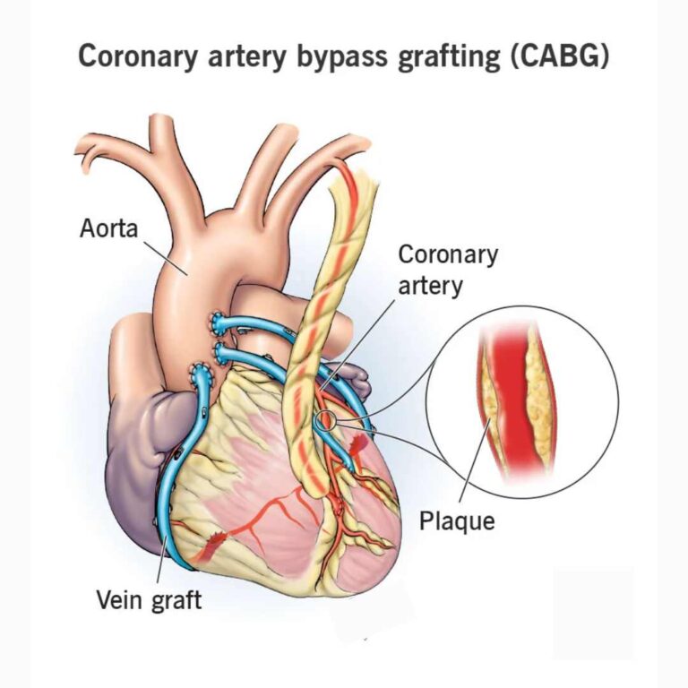 Coronary Artery Bypass Grafting